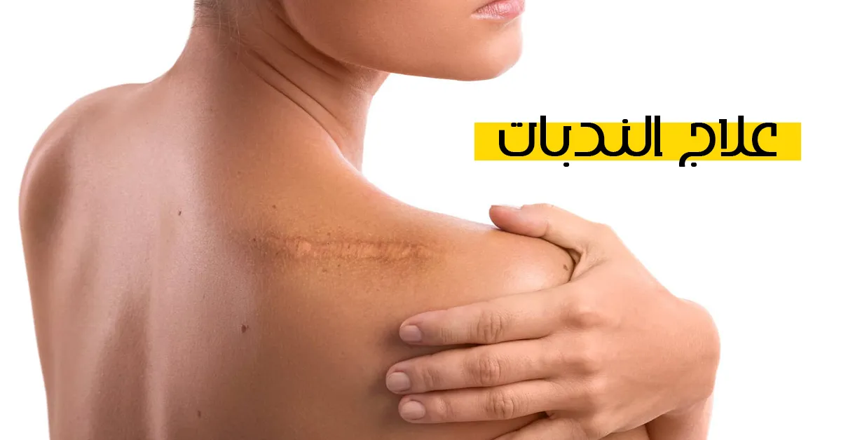 علاج الندبات